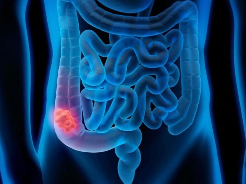 Υπουργείο Υγείας: Δωρεάν self tests στους άνω των 50 ετών για τον καρκίνο του παχέος εντέρου