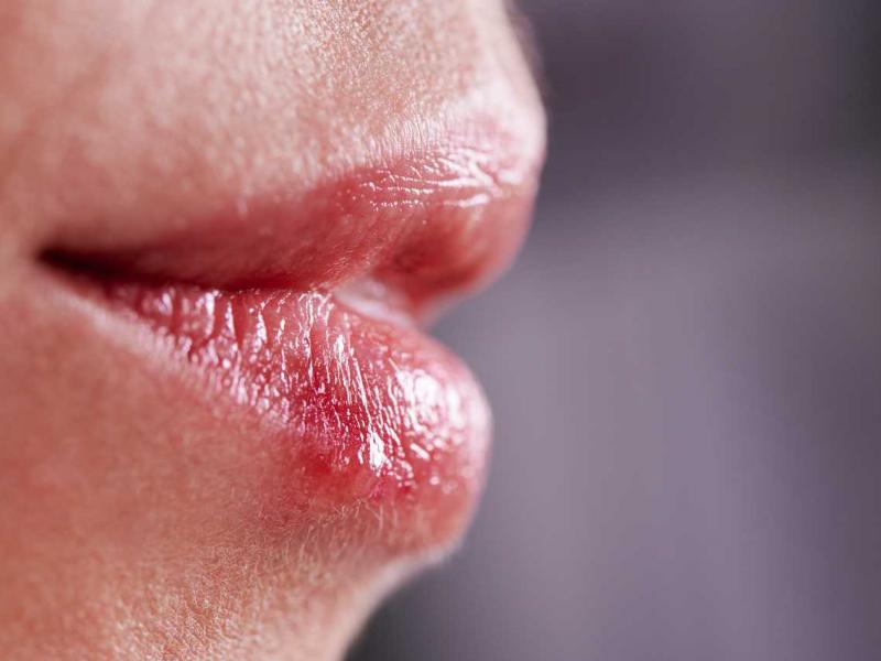 Επιχείλιος έρπης