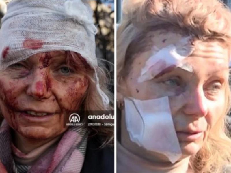 Τραυματισμένη δασκάλα στην Ουκρανία
