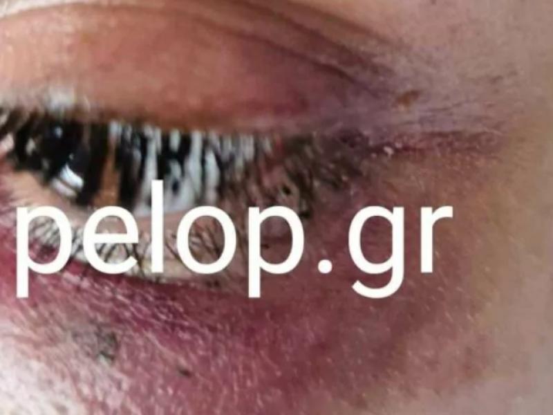 Ξυλοδαρμός κοπέλας από μπράβο