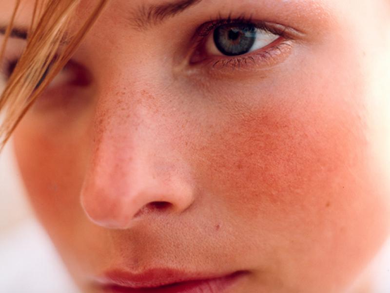 Κοκκίνισμα στο πρόσωπο