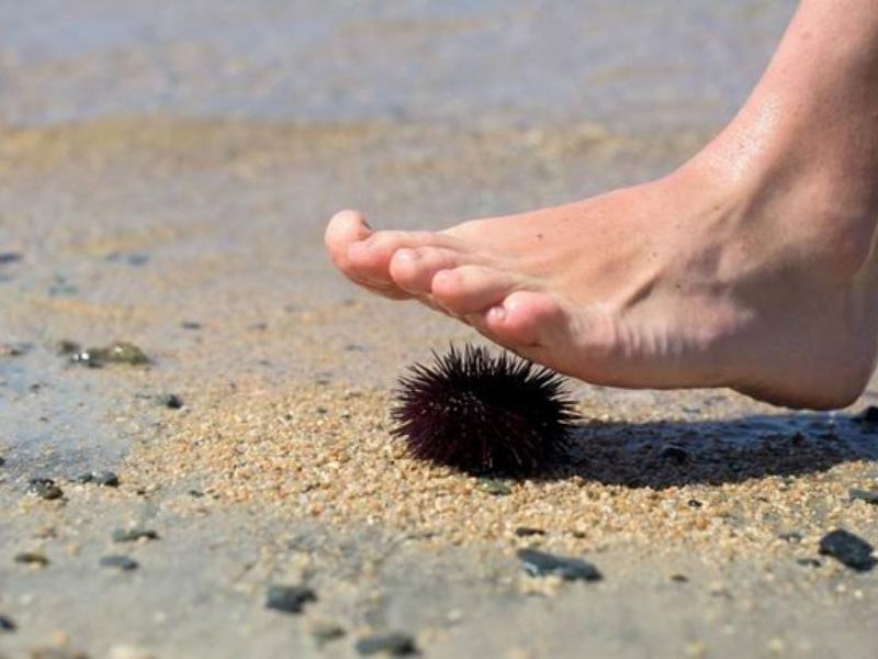 Τσίμπημα από αχινό