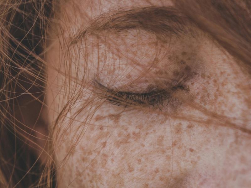 Πανάδες και φακίδες