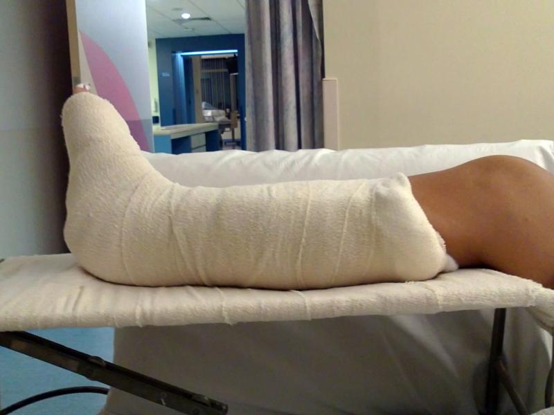 Σπασμένο πόδι