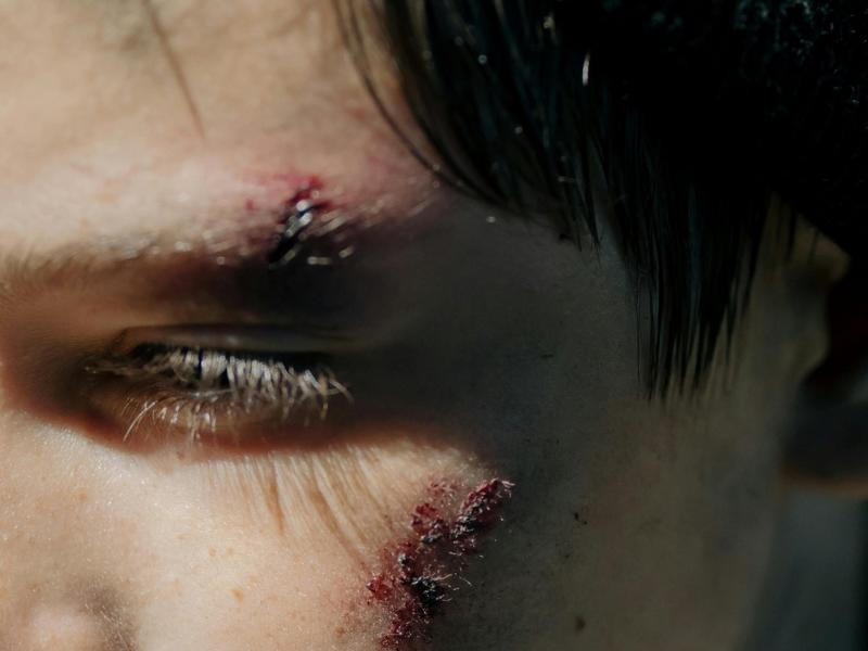 Πληγές - τραυματισμός