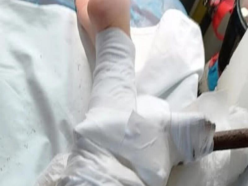 Ομπρέλα θαλάσσης καρφώθηκε στο πόδι μιας 26χρονης γυναίκας