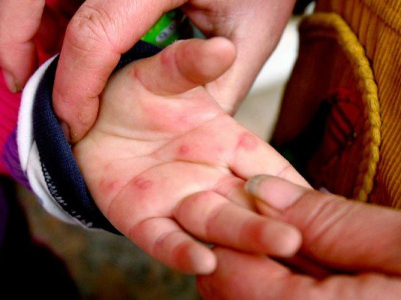 hand-foot-and-mouth-disease-666x399.jpg
