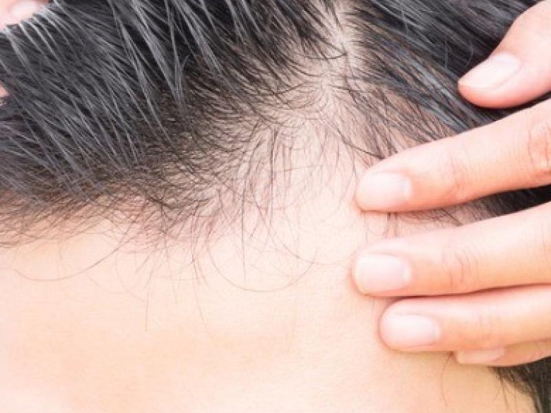 τριχόπτωση